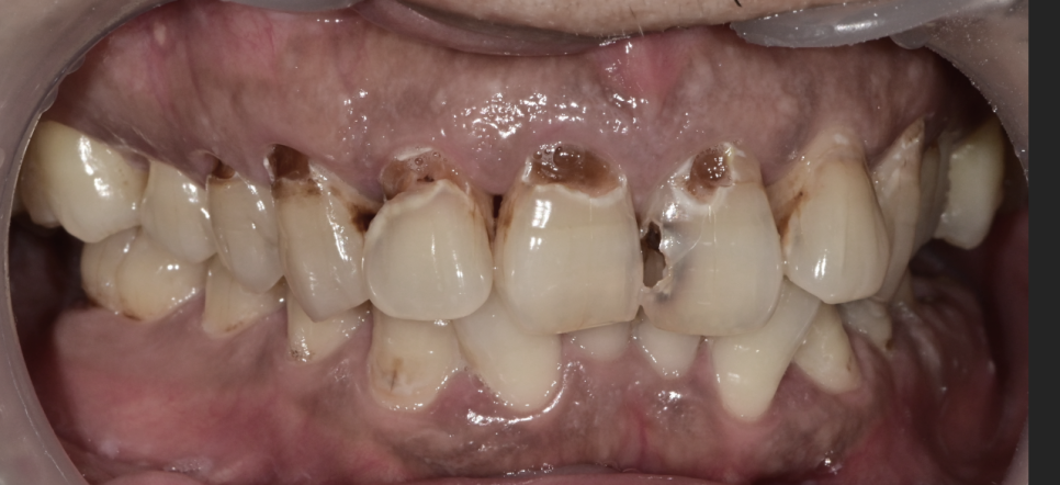 약수역 치과, 미뤄둔 임플란트 치료하기 (치과가 무서워요) 관련 이미지 4