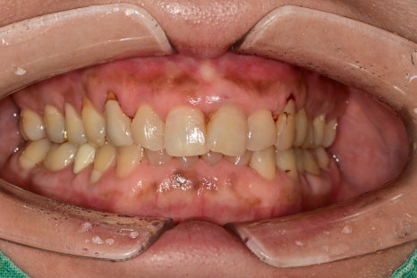 신당동치과 심미보철을 이용한 고른 앞니 만들기 관련 이미지 1