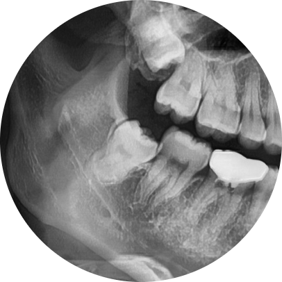 옥수역치과, 사랑니발치 사후관리까지 신경써야 관련 이미지 5