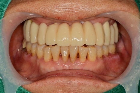 금호역 치과, 전체 틀니 대신 전체 임플란트로 가는 기간(식립위치의 선정의 중요성) 관련 이미지 4