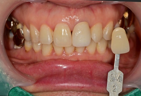 신당동 앞니 변색 치아 크라운치료 바른영치과 심미보철 케이스 관련 이미지 4