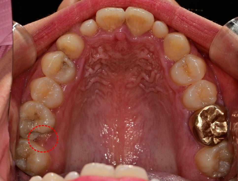 금호동 논골사거리 근처 치과에서 영구치 치료를 위한 잇몸성형술 관련 이미지 5