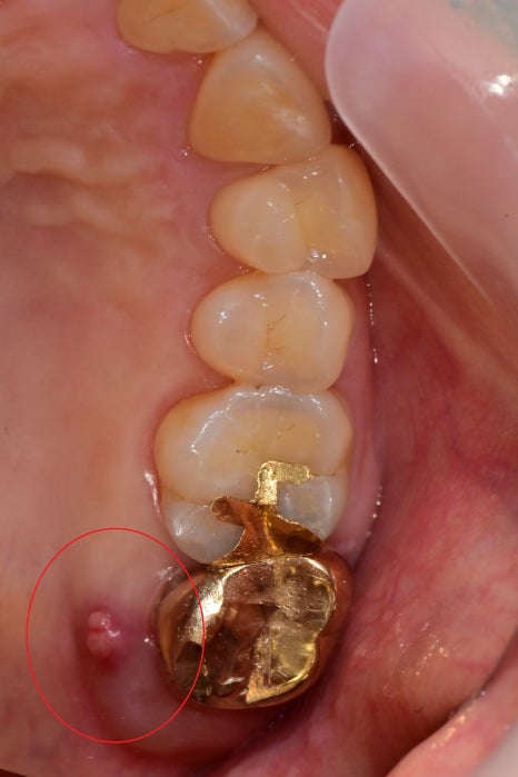 약수역 치과, 신경치료된 치아 뿌리 주변 염증이 생겼을 때 발치 후 발치와 보존술 처치( 임플란트 식립을 위한 치료 ) 관련 이미지 2