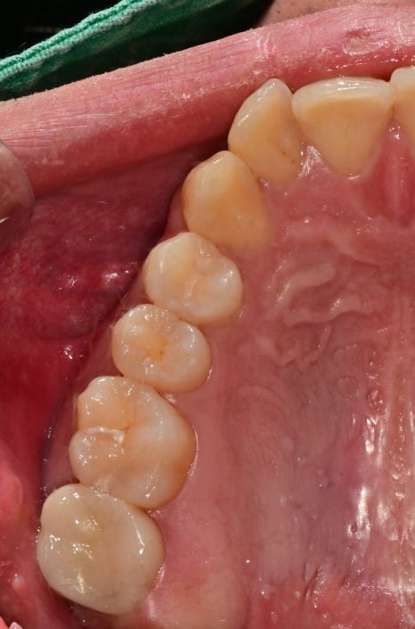 서울중구치과치료 신경치료받은 치아 크라운이 필요한가요? 관련 이미지 4