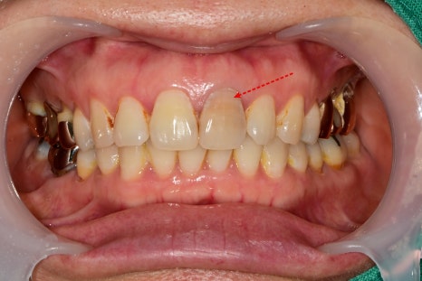 신당동 앞니 변색 치아 크라운치료 바른영치과 심미보철 케이스 관련 이미지 2