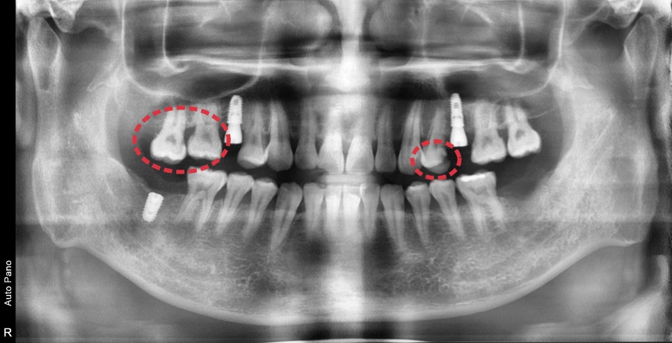 장충동 주변 치과 오래된 충치, 빠진 치아 부위 치료 방법 관련 이미지 4