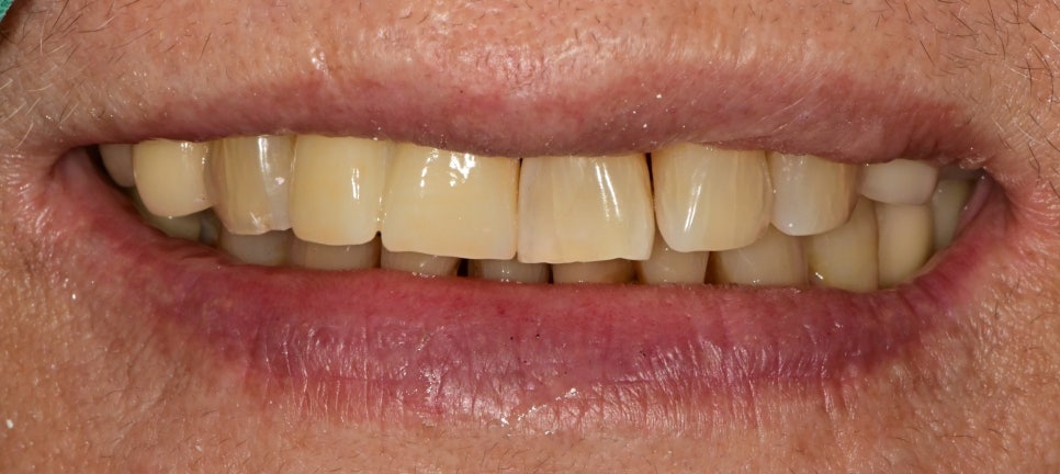 약수동 치과 내려앉은 잇몸 공간 치아삭제 없이 치료하기 관련 이미지 9