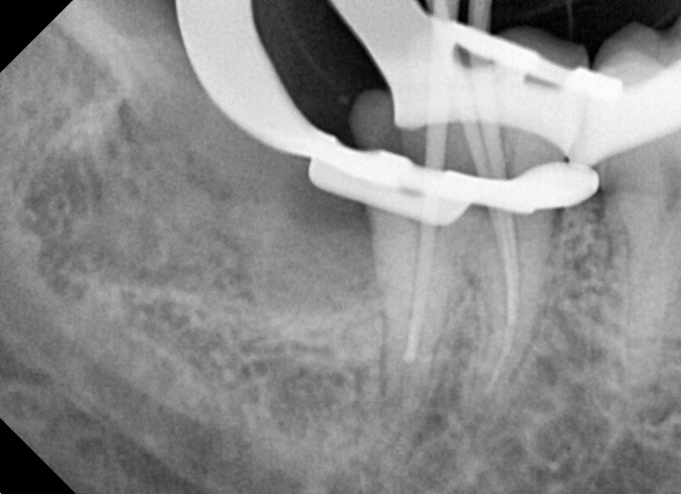 약수역 치과, 매복 사랑니 발치 (신경치료, 크라운치료) 관련 이미지 2