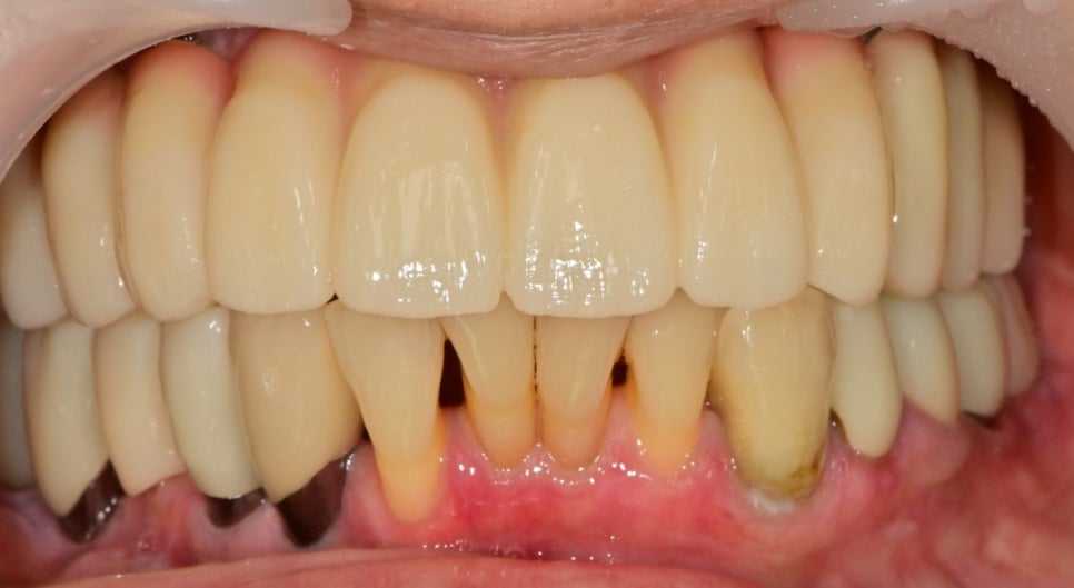 약수동 치과, 전체틀니 오래 쓰신분들 전체 임플란트 가능한가요??(치조골의 흡수양상과 모양) 관련 이미지 8