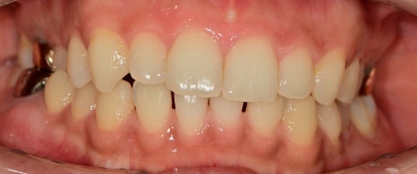 약수역치과 벌어진 앞니(치간이개) 레진을 이용한 치료방법 관련 이미지 4