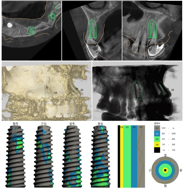 한남동 주변 치과 구강 스캐너를 이용한 가이드 임플란트 수술(무절개 수술) 관련 이미지 3