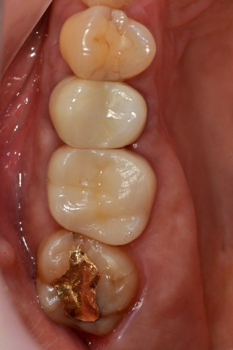 약수역 치과, 금간 치아는 신경치료를 꼭 해야 하나요?( 임플란트 전 크라운치료, MTA) 관련 이미지 5