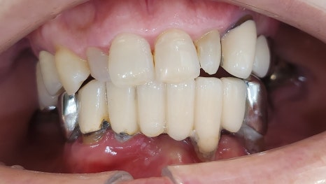 Full-Mouth Implants at Yaksu Station: Can You Have Teeth Immediately After Surgery? image 1