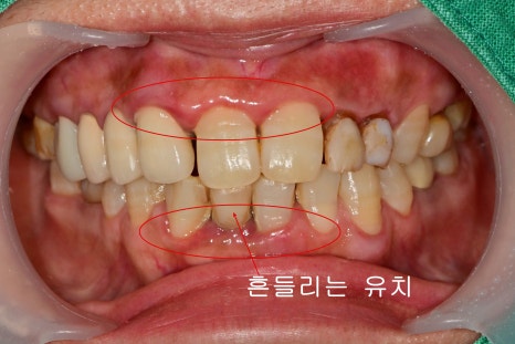 옥수동 치과, 성인유치 결손치 부분 앞니 보철, 임플란트 가능한가요 관련 이미지 2