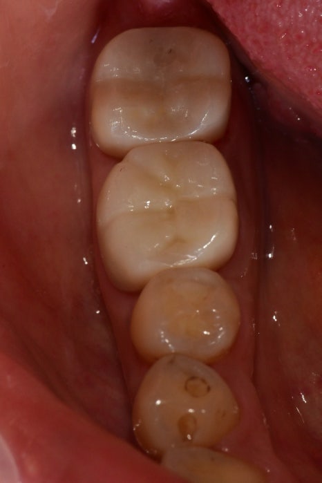 약수역 치과, 금간 치아는 신경치료를 꼭 해야 하나요?( 임플란트 전 크라운치료, MTA) 관련 이미지 6