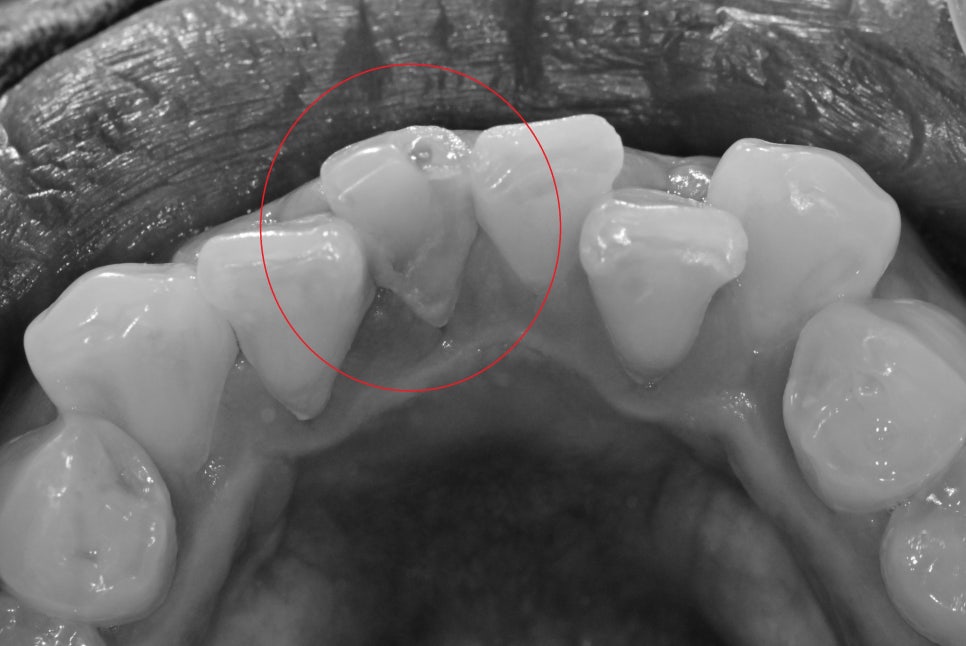 약수역 치과, 신경치료 시작 후 장기간 중단되었을 때 생길 수 있는 증상은?? 관련 이미지 3