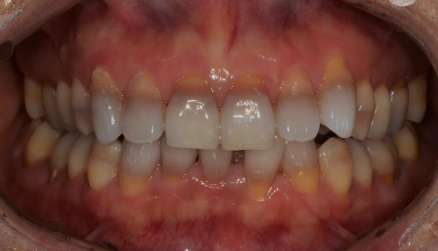 약수역 치과, 치아 미백 1회 방문으로 효과가 있을까?(feat. 원데이 미백) 관련 이미지 3