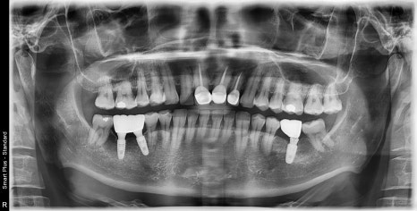 약수역 치과 , 전치부 심미보철 재제작할때 주의할 점 ( 항상 무삭제 라미네이트가 가능한 것인가??) 관련 이미지 1