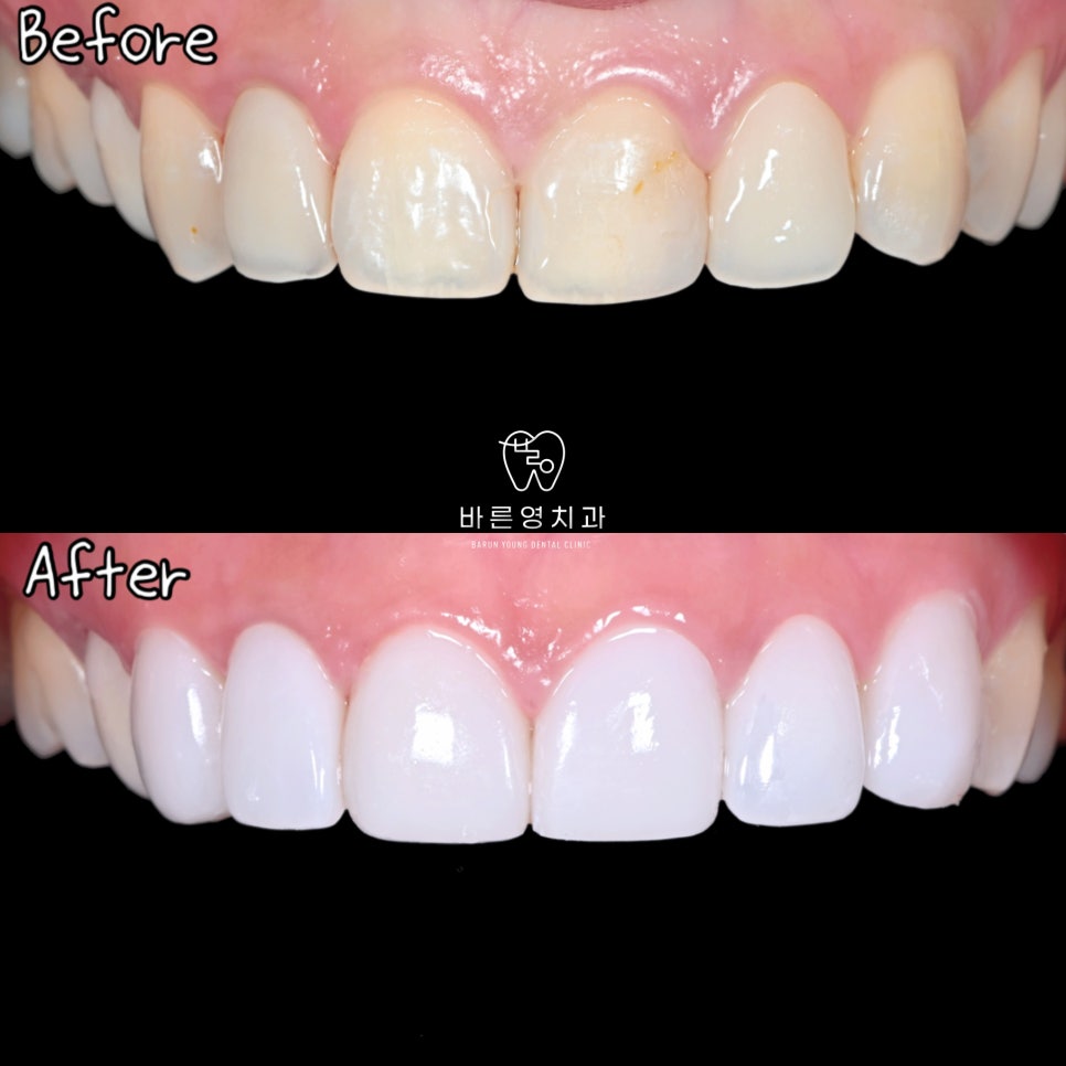 약수역 치과 라미네이트를 하고싶다면 이것부터 이해하면 좋습니다(밝은 미소를 되찾아가는 과정) 관련 이미지 6