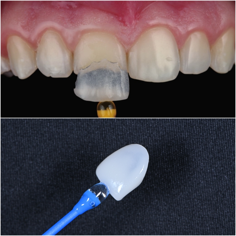 약수역 치과 라미네이트를 하고싶다면 이것부터 이해하면 좋습니다(밝은 미소를 되찾아가는 과정) 관련 이미지 1