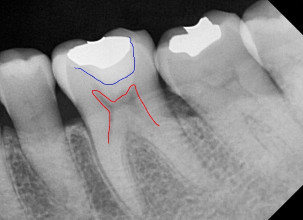 약수동 치과, crack 치아 (금간 치아)의 오래된 수복물 제거 후 치료방법( MTA, 깊은충치) 관련 이미지 2