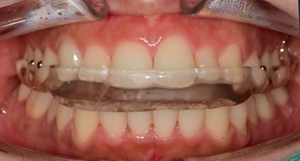동대입구역 치과 이갈이 장치 제작이 필요한 경우(턱관절 통증) 관련 이미지 5