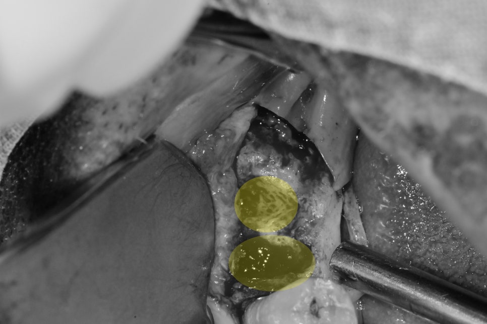 청구역 치과 치주염으로 다수의 치아가 흔들리는 경우(발치, 임플란트) 관련 이미지 6