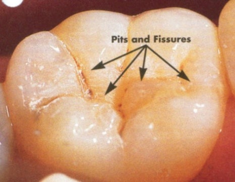 약수역치과 깊은 충치 신경치료 없이 치료하는 방법( MTA치료 ) 관련 이미지 2
