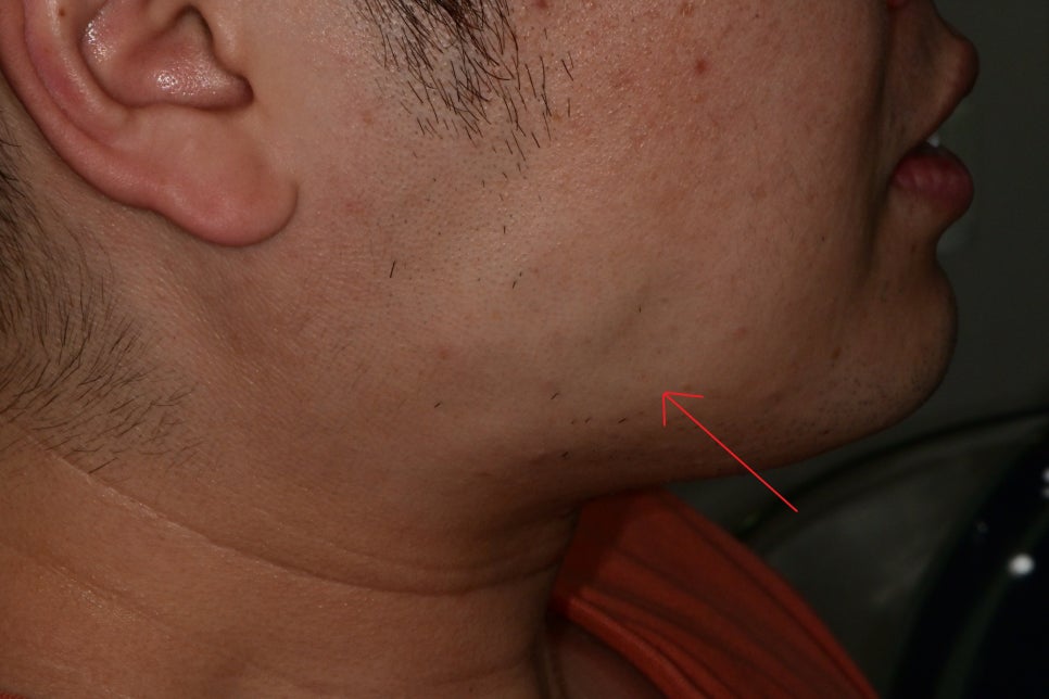 신당동 치과, 턱 보톡스 주사 이후에 나타날 수 있는 증상 ( 사각턱, 저작근, 볼 알사탕 현상) 관련 이미지 2