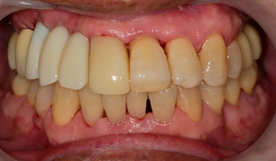 신당역 임플란트 풍치, 심한 치주염인 경우 치과에서 치료 순서 관련 이미지 9