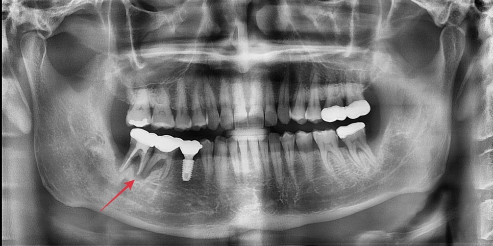 동대문 치아뿌리 염증 방치하면 치과 임플란트 기간에 영향을 줍니다 관련 이미지 4