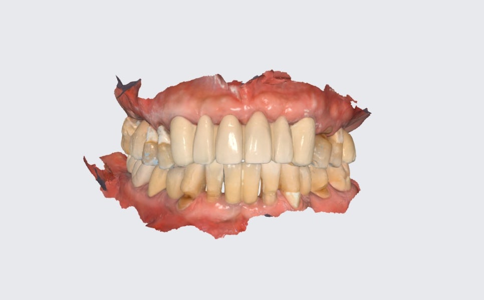 한남동 주변 치과 구강 스캐너를 이용한 가이드 임플란트 수술(무절개 수술) 관련 이미지 2
