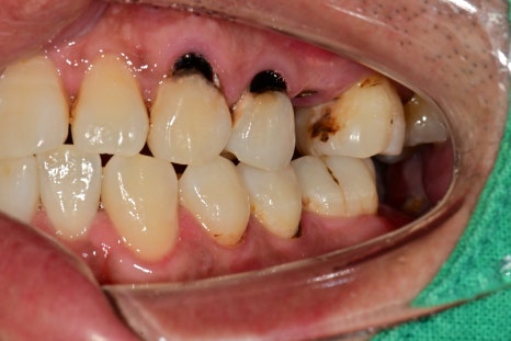 장충동 주변 치과 오래된 충치, 빠진 치아 부위 치료 방법 관련 이미지 3