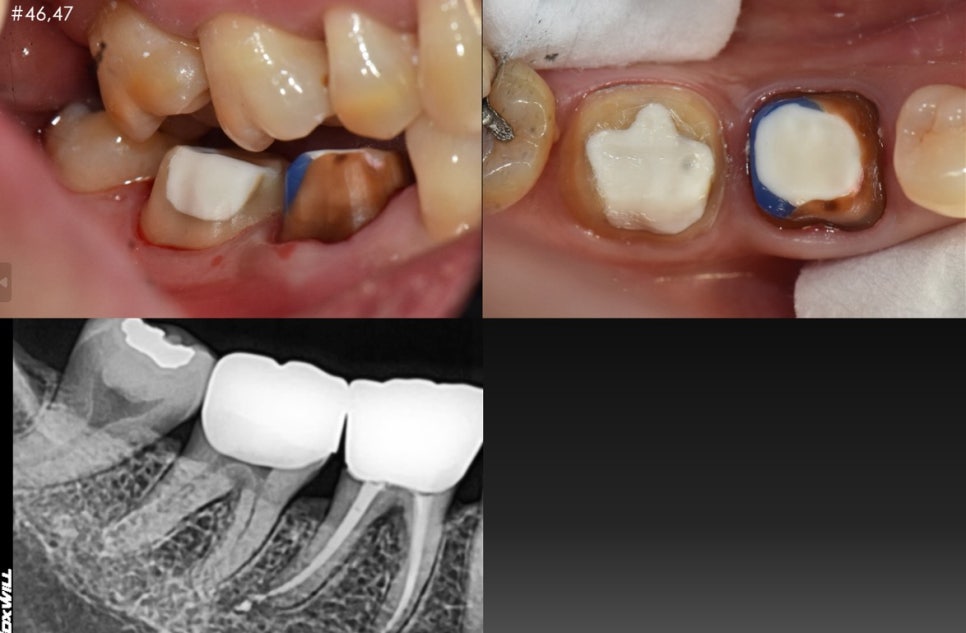 옥수동 치과, 신경치료 돼있는 치아 잇몸의 염증, 고름주머니가 생겼을 때 약을 먹어도 안 가라앉아요. ( 생기는 원인과 치료방법) 관련 이미지 5