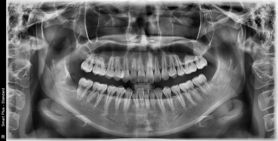 신당동 치과, 사랑니는 꼭 빼야 하나요?? 매복 사랑니 발치 시 유의할 점? (발치 후 통증 및 붓기) 관련 이미지 4