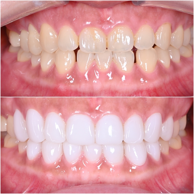 약수역 치과 라미네이트의 완성은 관리에서 시작합니다 관련 이미지 1