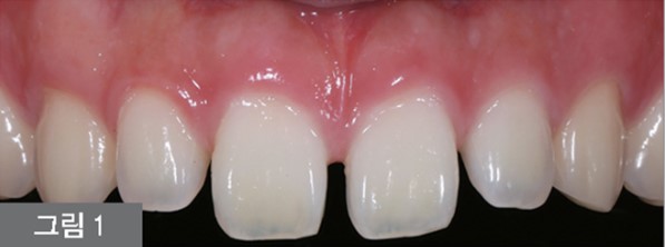 약수역치과 벌어진 앞니(치간이개) 레진을 이용한 치료방법 관련 이미지 1