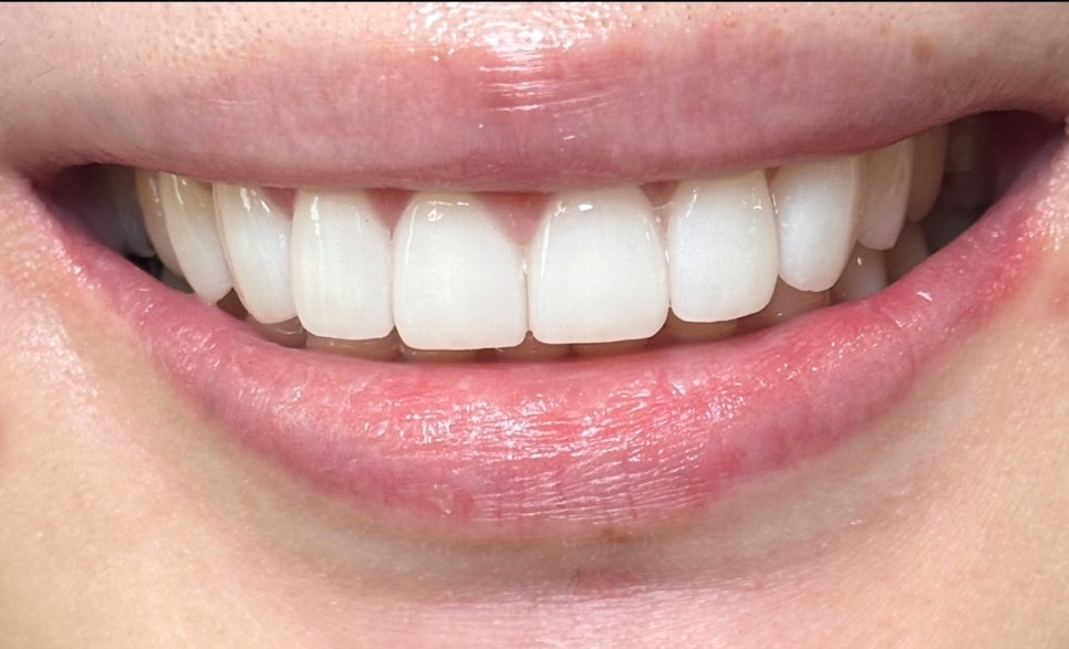 신당 라미네이트 치과 미세삭제로 예쁜 미소 만들기 관련 이미지 3