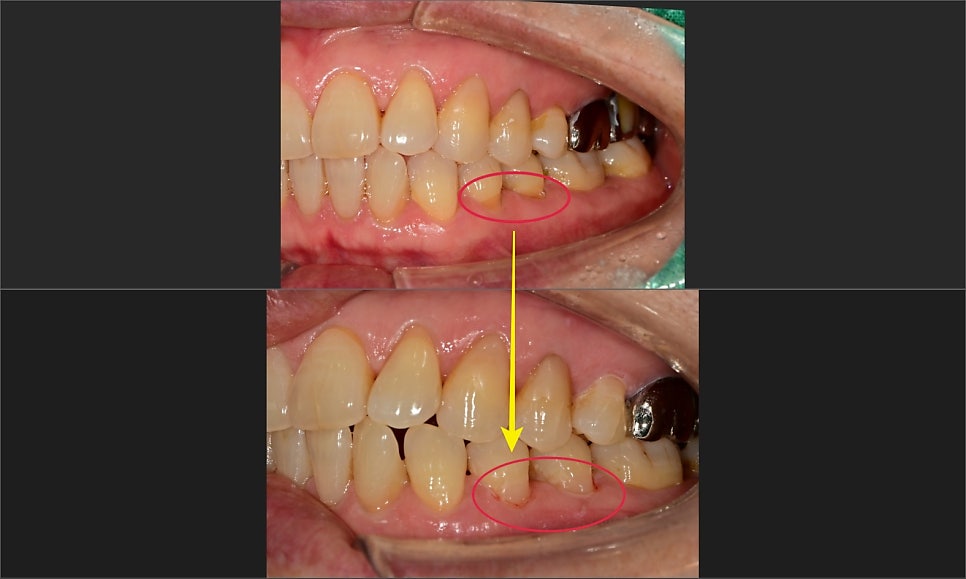 약수동 임플란트 염증으로 인한 발치 후 임플란트 식립( 상악동 거상술) 관련 이미지 1