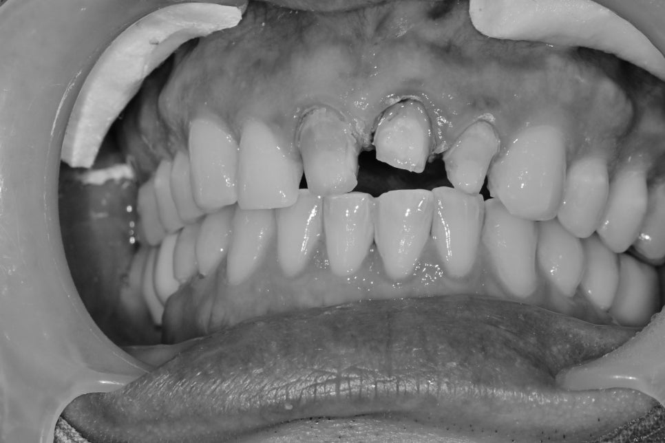 약수역 치과 , 전치부 심미보철 재제작할때 주의할 점 ( 항상 무삭제 라미네이트가 가능한 것인가??) 관련 이미지 3