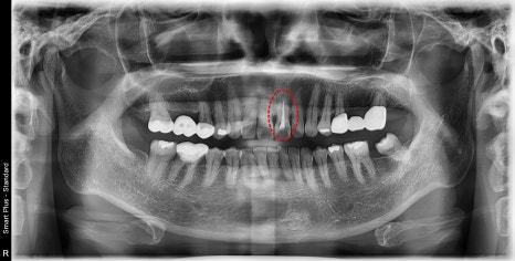 신당동 앞니 변색 치아 크라운치료 바른영치과 심미보철 케이스 관련 이미지 1