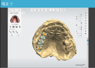 한남동 치과 디지털을 이용한 오차는 줄이고 편안함은 높이는 임플란트 관련 이미지 4