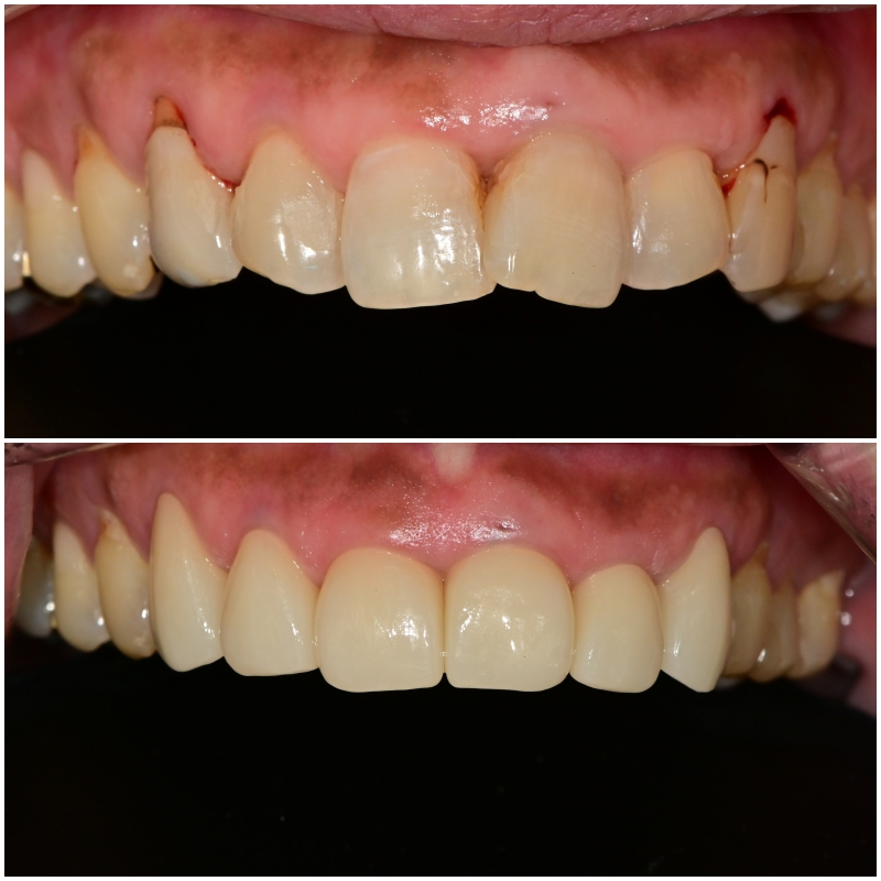 신당동치과 심미보철을 이용한 고른 앞니 만들기 관련 이미지 8