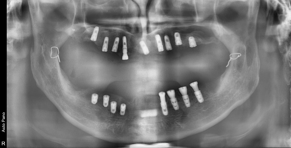약수역치과 전체임플란트 진행과정 (상악동 거상술) 관련 이미지 6