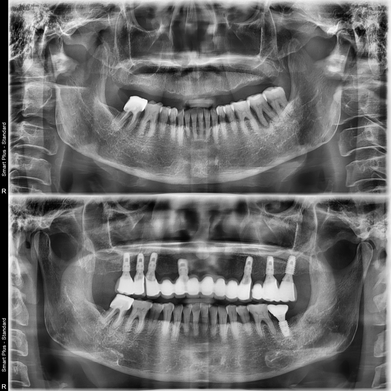 Dental Clinic Near Yaksu Station: How Many Implants Are Needed for Full-Mouth Implants? image 1