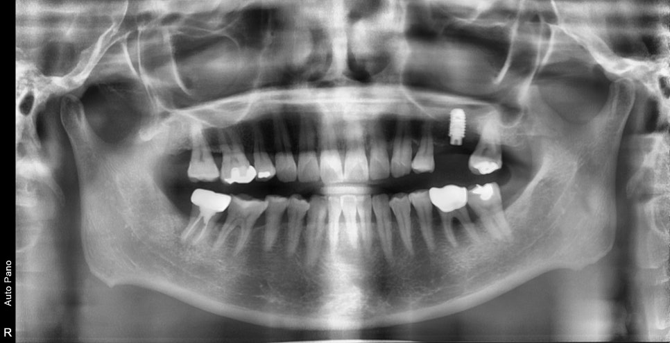 약수역 임플란트, 발치 후 임플란트 수술 언제 가능한가? 관련 이미지 7