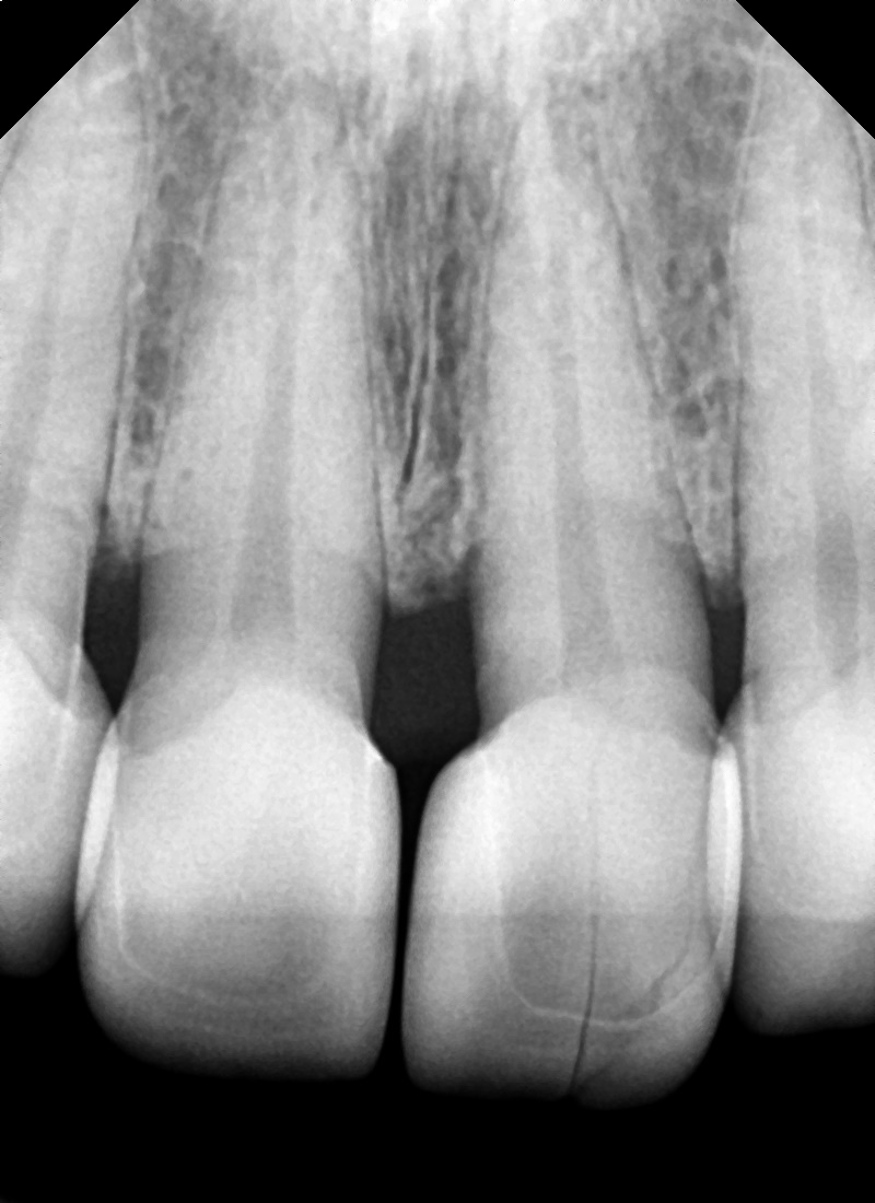 약수역 치과, 전치부 심미 보철 재치료(보철물 파절의 원인) 관련 이미지 2
