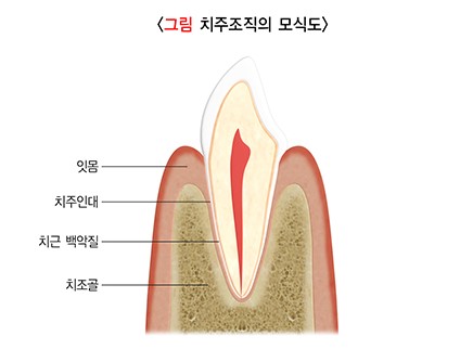 약수동 치과 내려앉은 잇몸 공간 치아삭제 없이 치료하기 관련 이미지 1