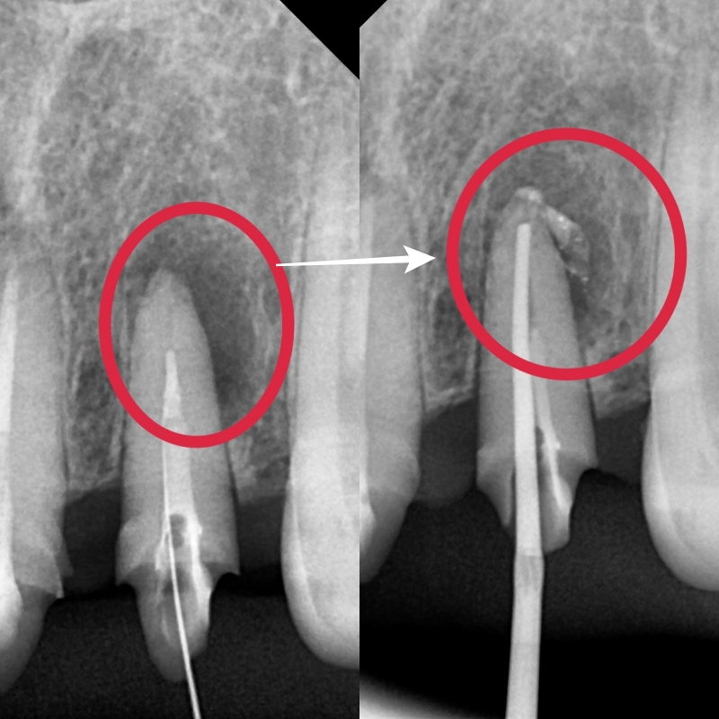 금호역치과 비율이 안 맞는 앞니 재보철치료 관련 이미지 2