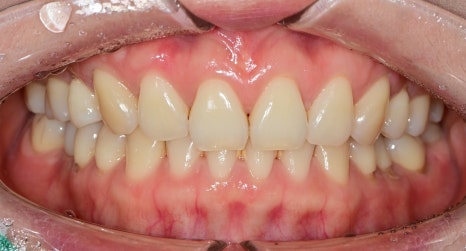 동대문 무삭제라미네이트 과거 교정한 치아가 웃을 때 안 보여 스트레스일 때 관련 이미지 1